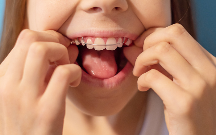 小児矯正を早めに始めるとこんなに違う