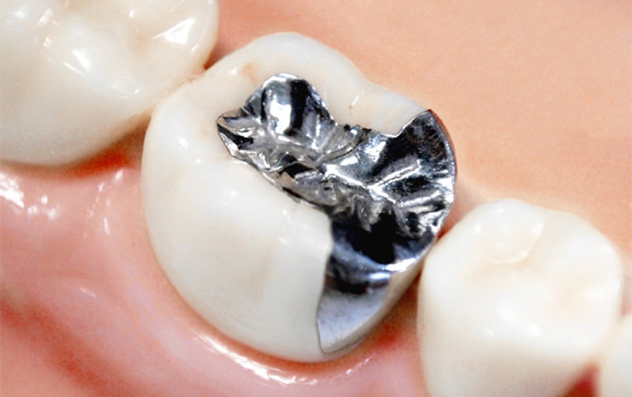 健康な歯を守る虫歯治療(MI治療)