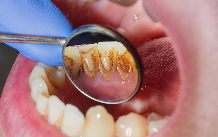 歯周病の原因