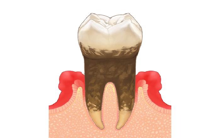 中等度歯周炎